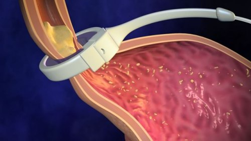 Бандаж на желудок - лечение в Германии